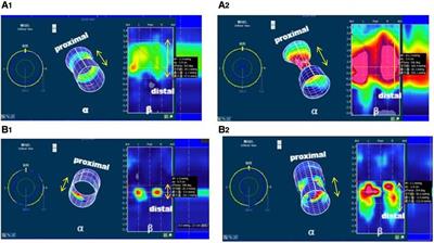 Three dimension high definition manometry evaluated postoperative anal canal functions in children with congenital anorectal malformations